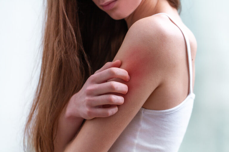 TCM for Eczema in Singapore: A Holistic Approach to Skin Health